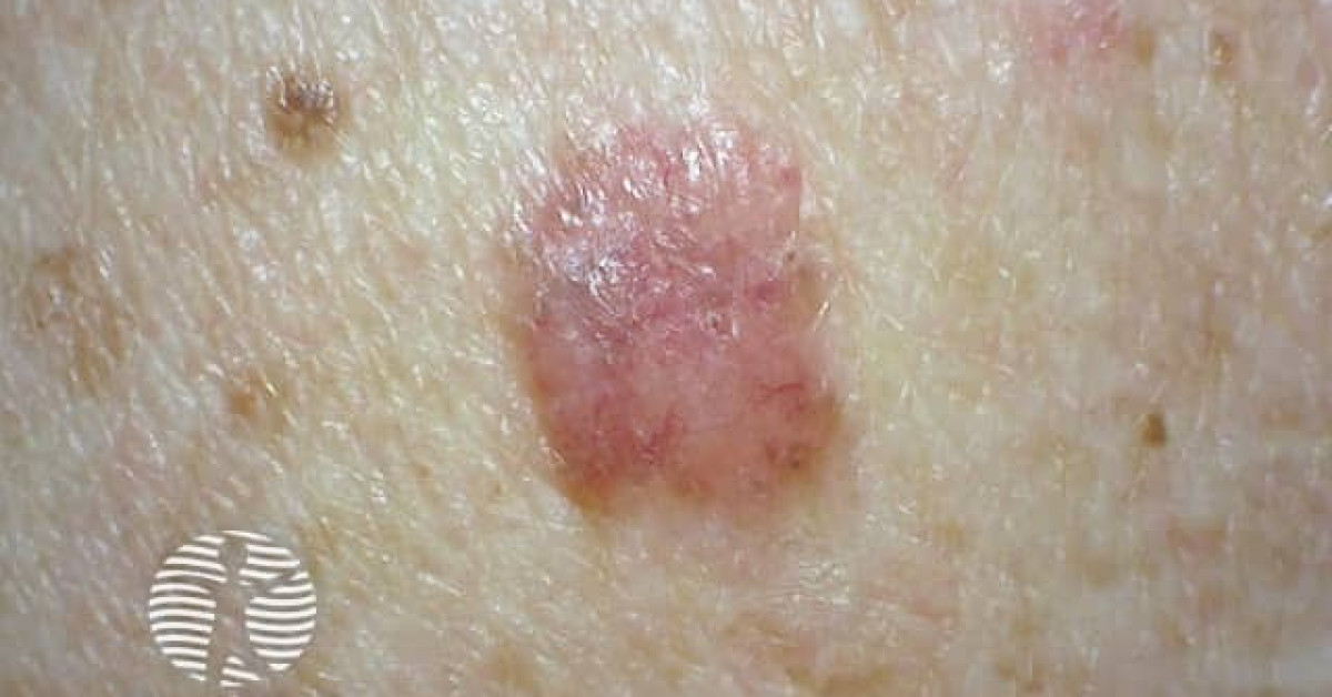 Nodular Basal Cell Carcinoma Image