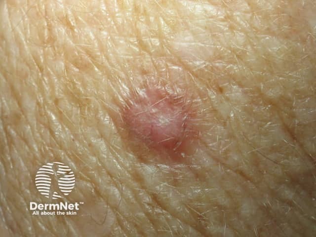 Basal cell carcinoma affecting the arms and legs 3 macro