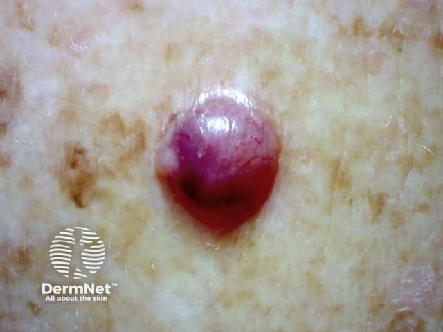 Basal cell carcinoma affecting the arms and legs 4 macro