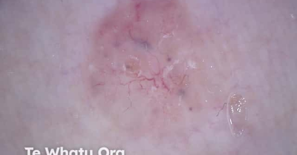 Nodular basal cell carcinoma dermoscopy image