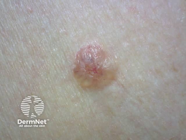Basal cell carcinoma affecting the arms and legs 5 macro