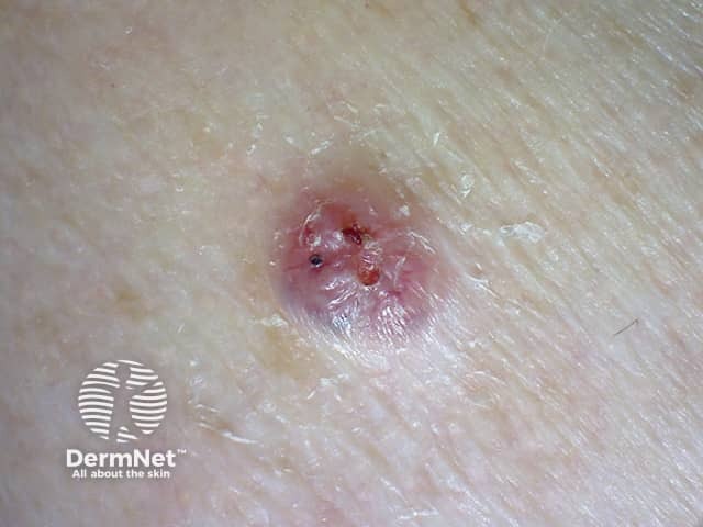 Basal cell carcinoma affecting the arms and legs 6 macro