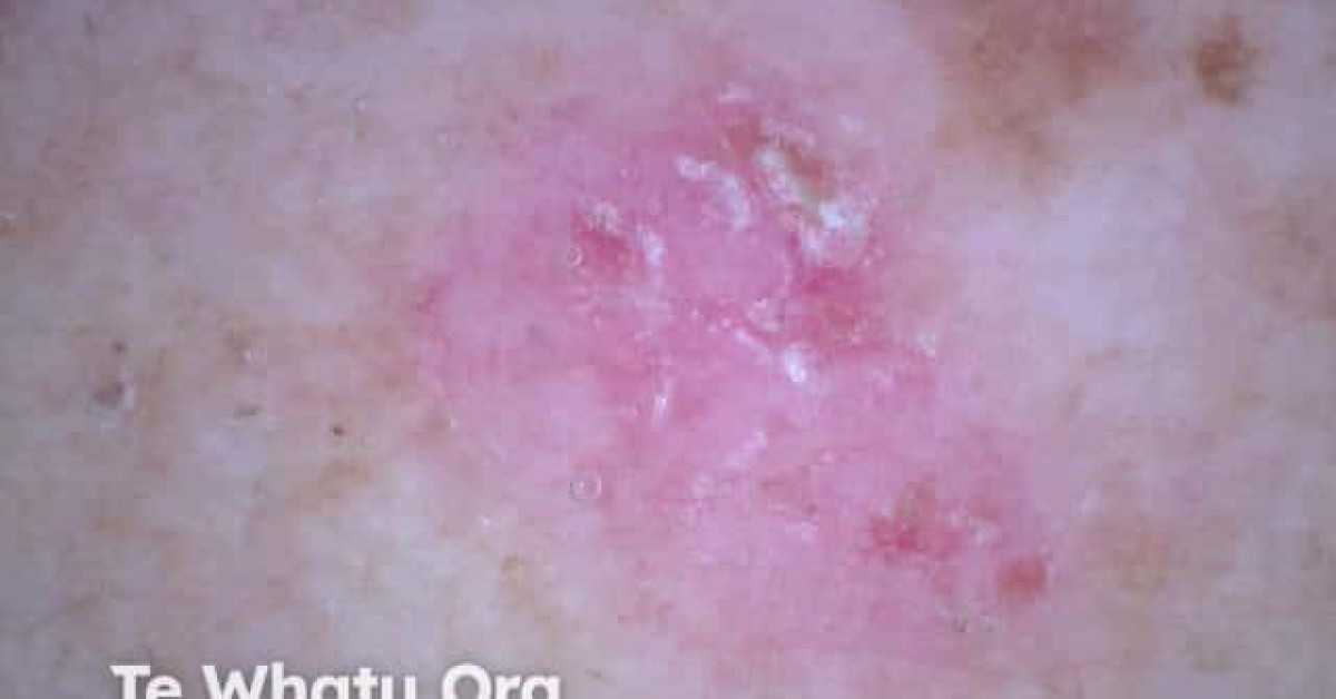 DermNet® - Superficial basal cell carcinoma 2 dermoscopy image