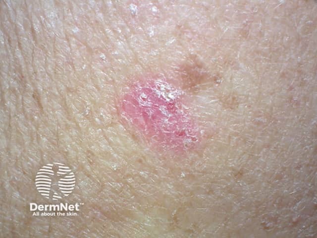 Basal cell carcinoma affecting the arms and legs 7 macro