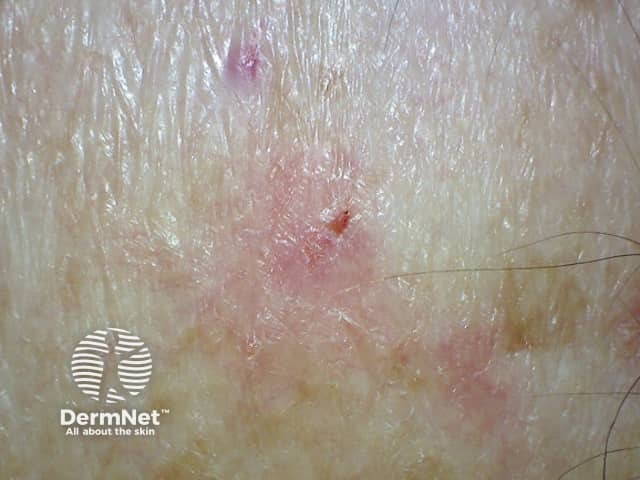 Basal cell carcinoma affecting the arms and legs 8 macro