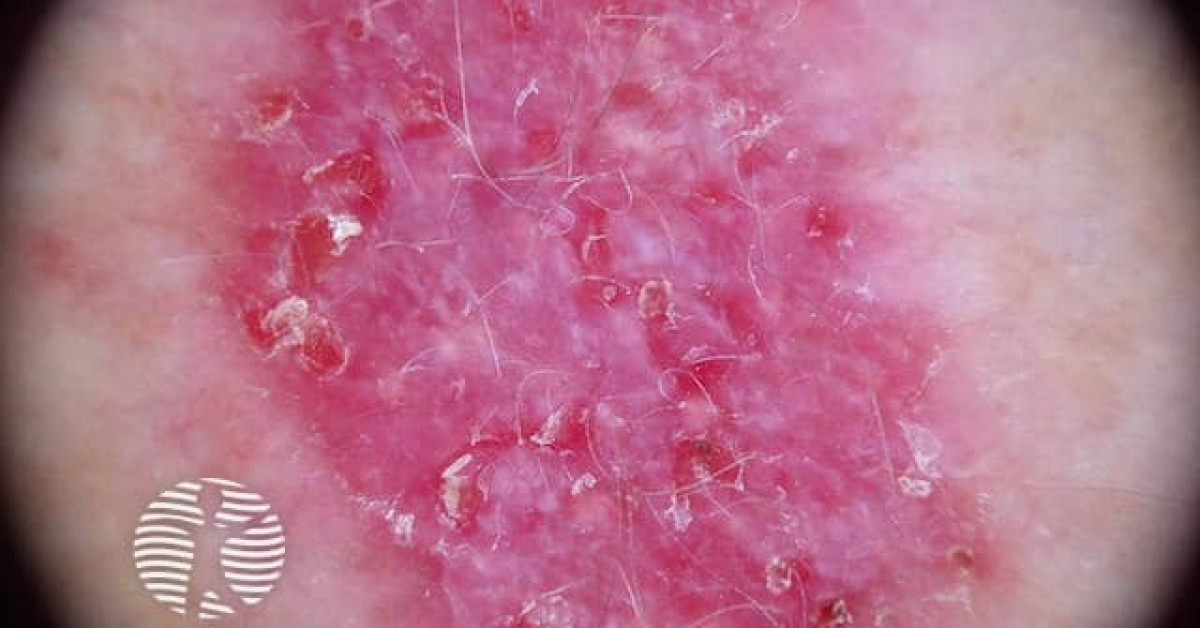 Superficial basal cell carcinoma 4 dermoscopy image