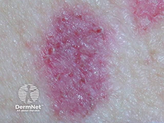 Basal cell carcinoma affecting the arms and legs 9 macro
