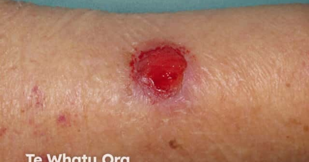 Basal Cell Carcinoma Arm Image 9244