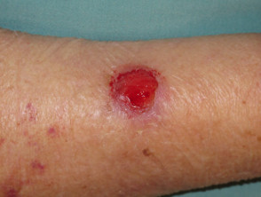 Basal cell carcinoma, arm