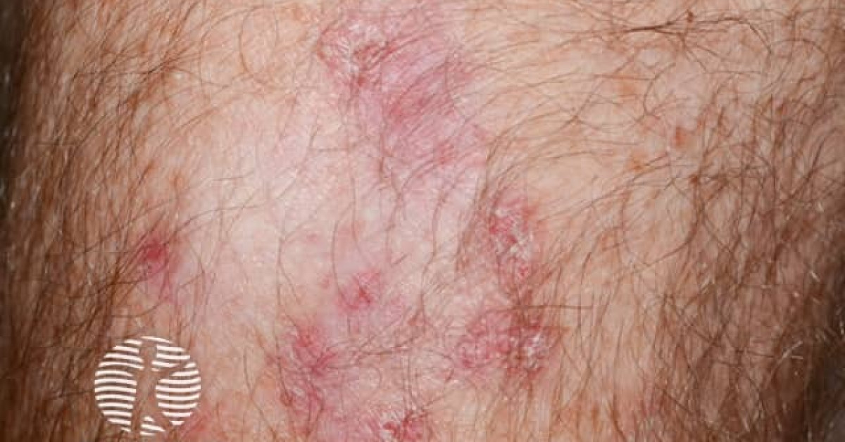 Basal cell carcinoma, arm image