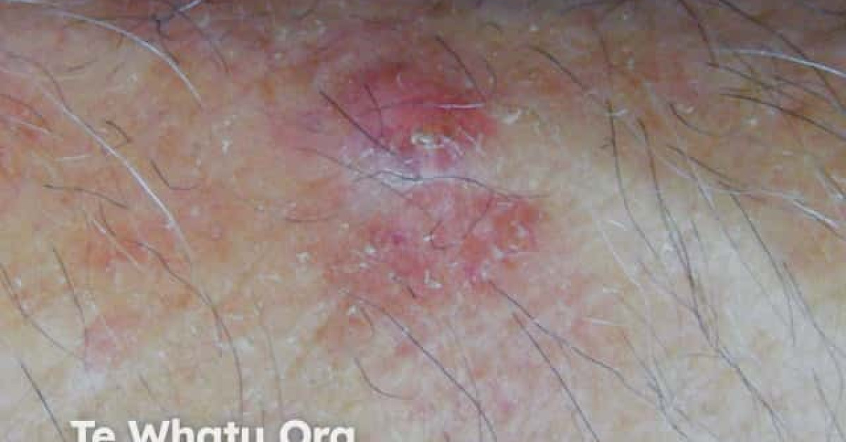 Basal Cell Carcinoma Arm Image 4473