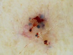 Blue-grey ovoid nests in pigmented basal cell carcinoma dermoscopy