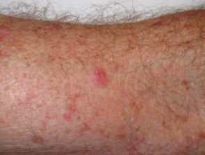 basal cell carcinoma on arm