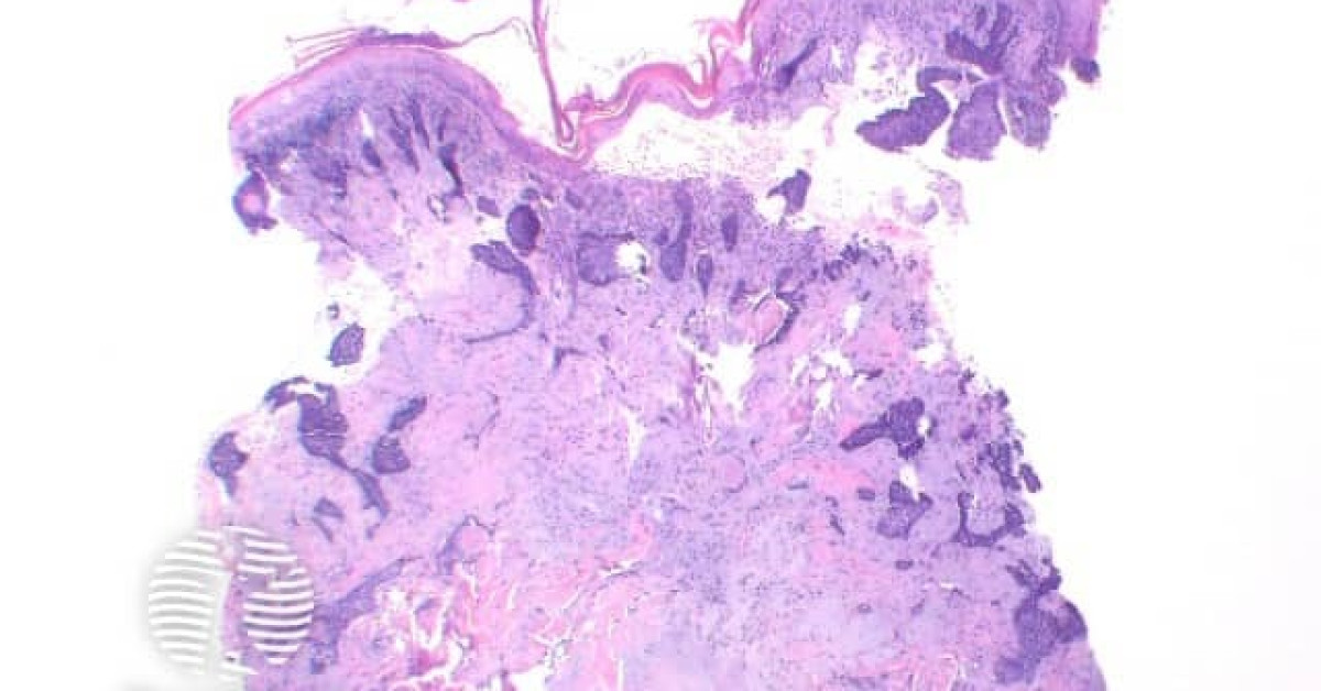 Basal cell carcinoma pathology image