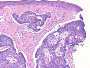 Basal Cell Carcinoma Pathology Dermnet Nz