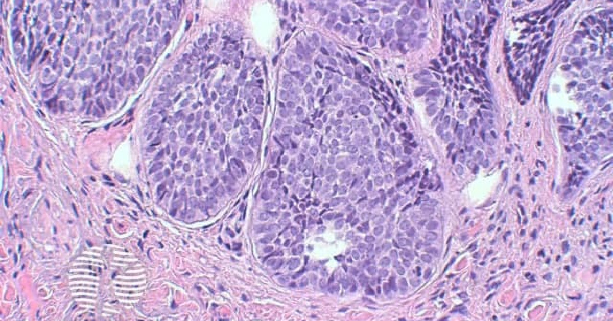 Basal cell carcinoma pathology image