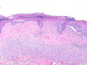 Basal Cell Carcinoma Pathology Dermnet Nz
