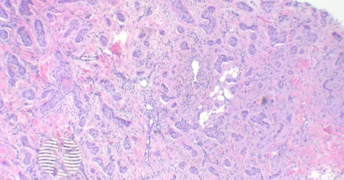 Basal Cell Carcinoma Pathology Image