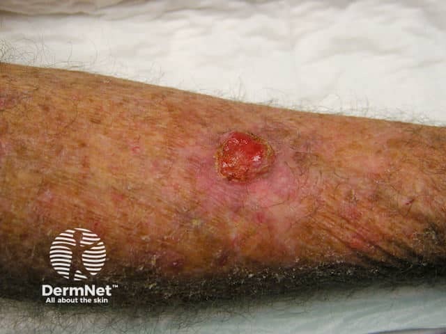 Basal cell carcinoma, leg