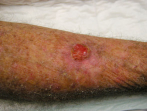 Basal cell carcinoma, leg