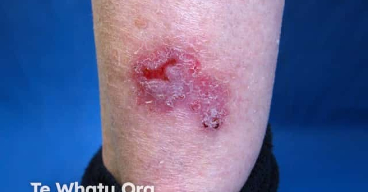 DermNet® - Basal cell carcinoma, leg image