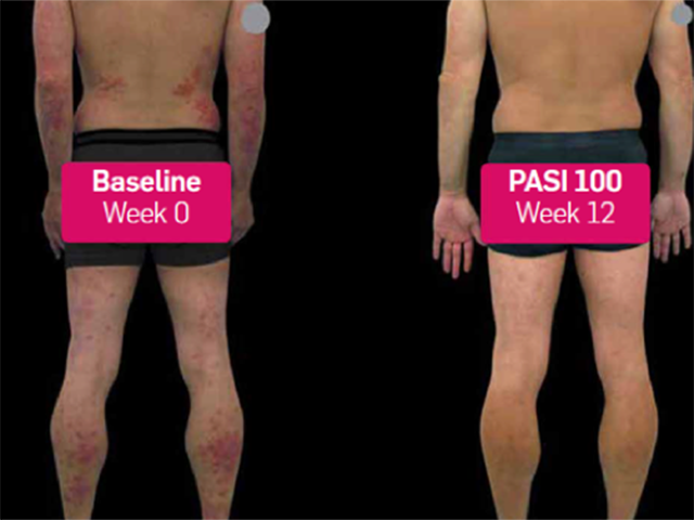 Before and after secukinumab