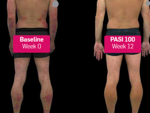 Before and after secukinumab