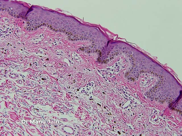 Histology of a benign keratosis