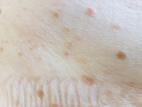 mite bites on humans face