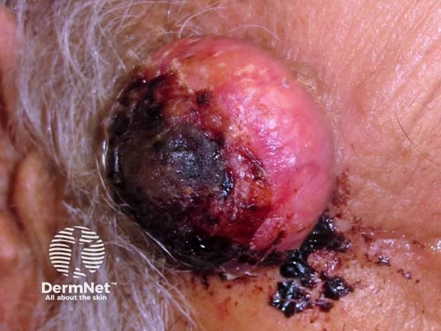 Crusted squamous cell carcinoma