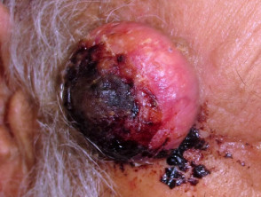 Crusted skin cancer