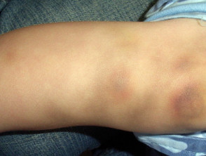 Bruises due to haemophilia