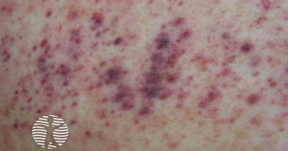 bleeding disorder 09 image