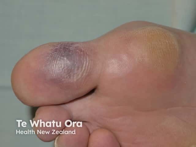 Blue toe syndrome: ischaemia