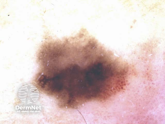 Pigmented intraepidermal carcinoma dermoscopy