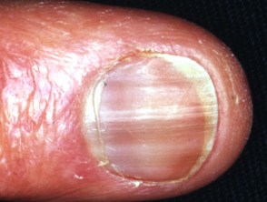Nail pigmentation due to hydroxyurea