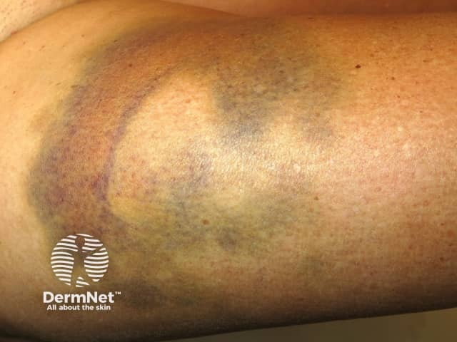 Traumatic bruise