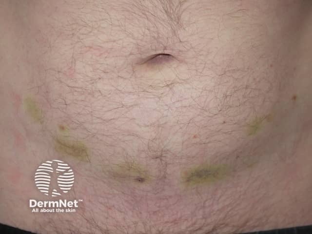 Bruising at the site of heparin injections