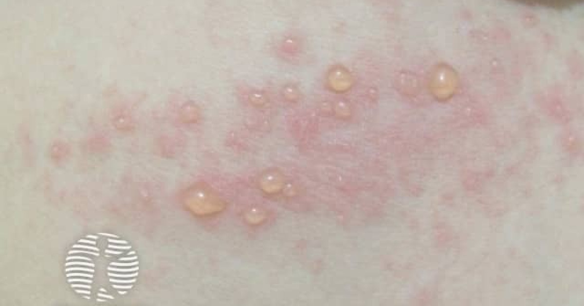Bullous pemphigoid image