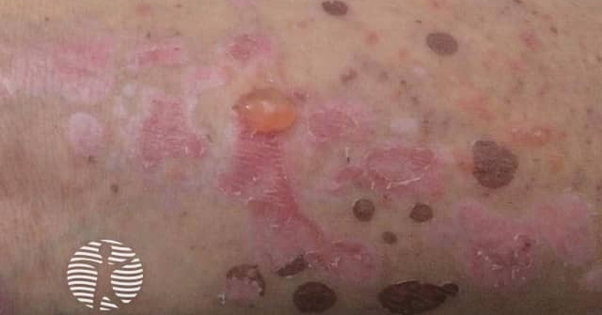 Bullous Pemphigoid Image