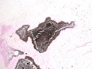 calcinosis cutis von Kossa silver stain