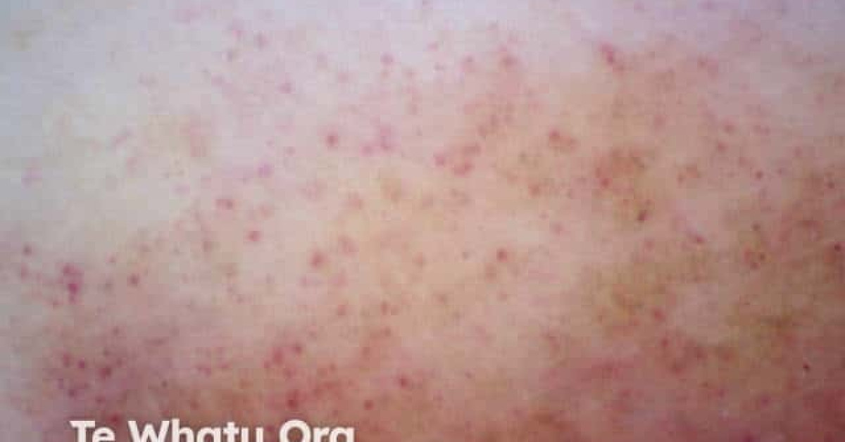 Dermoscopy of capillaritis image