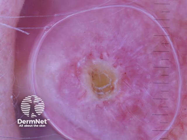 Chondrodermatitis nodularis helicis dermoscopy