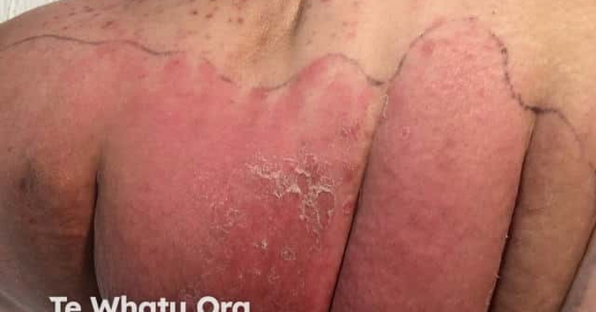 Cellulitis image