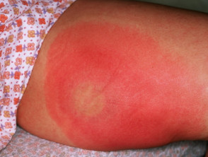 Differentiating between red legs and cellulitis