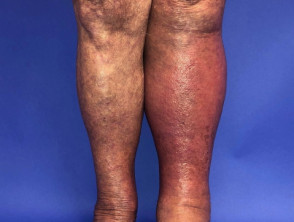 Cellulitis of the left leg