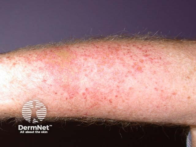 Acute irritant contact dermatitis