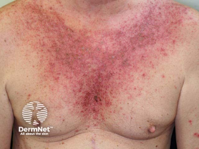 Eczematous dermatitis on male undergoing chemotherapy treatment