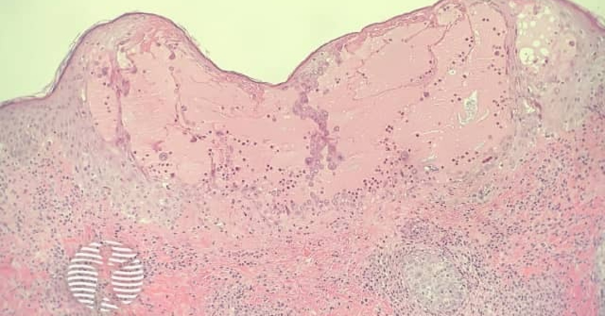 Chickenpox Pattern Chickenpox image