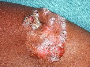 Macro image of chromoblastomycosis